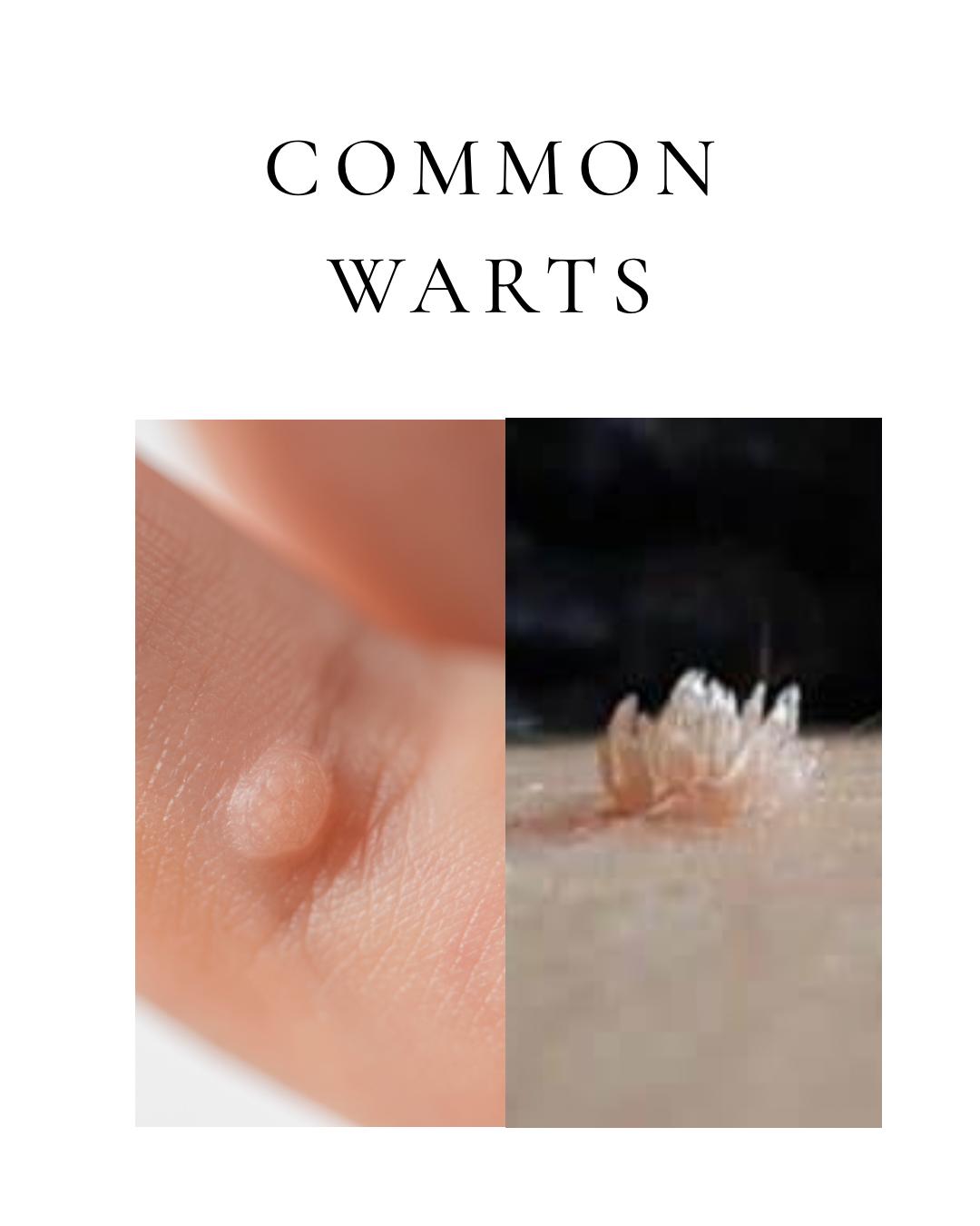 Common Warts